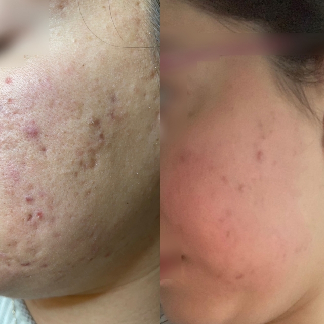 Trattamento laser viso e cura dell'acne